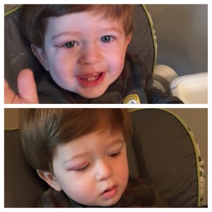 The black eye the next day!